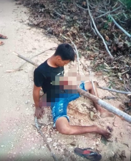 Jovem fica com tronco atravessado no peito após acidente de moto; Imagem é forte